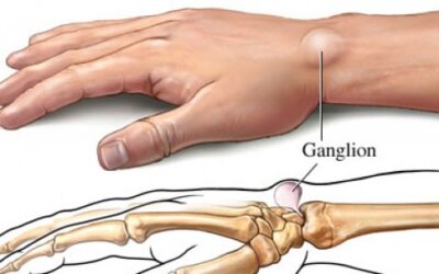 Do you suffer from ganglion cysts?