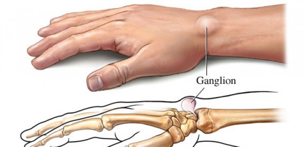 Do you suffer from ganglion cysts?